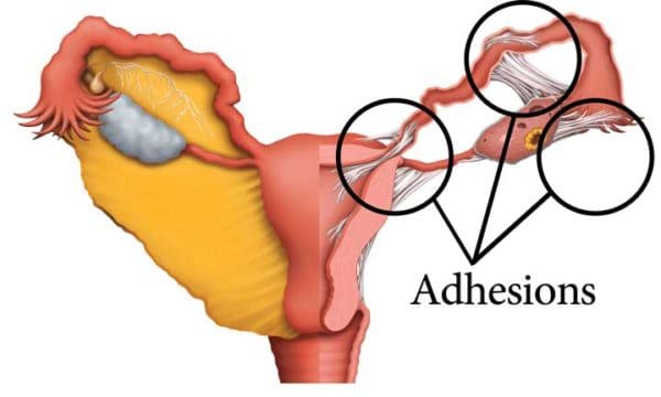Intrauterine Adhesions