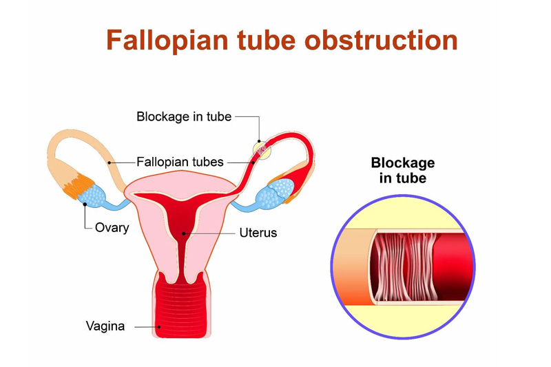 Blocked Fallopian Tubes
