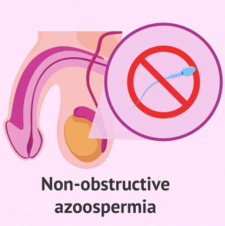 Nonobstructive Azoospermia