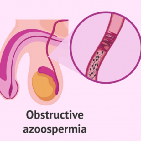 Obstructive Azoospermia
